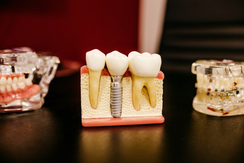 A dental implant model showing the titanium post and crown