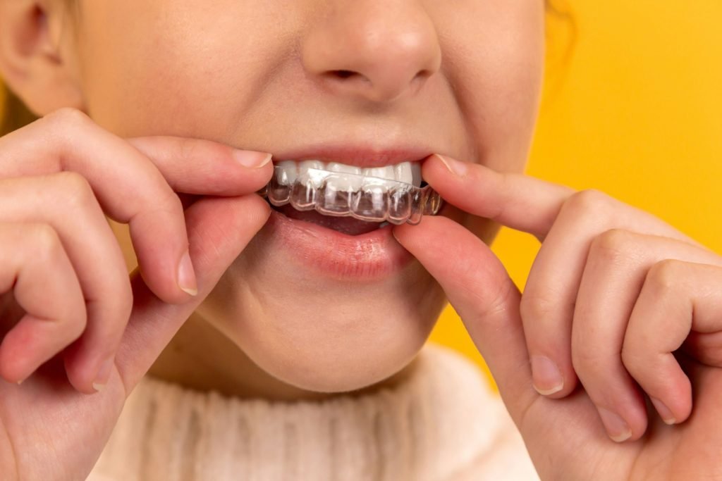 A clear plastic aligner being fitted over the teeth